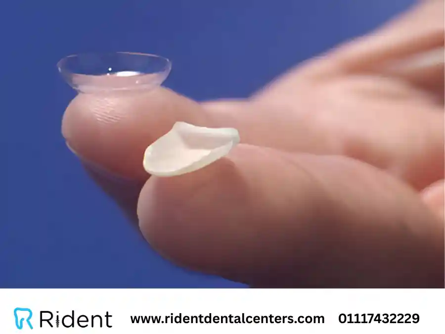 الفرق بين الفينير واللومينير